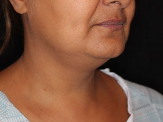 Awake Neck Liposuction Before