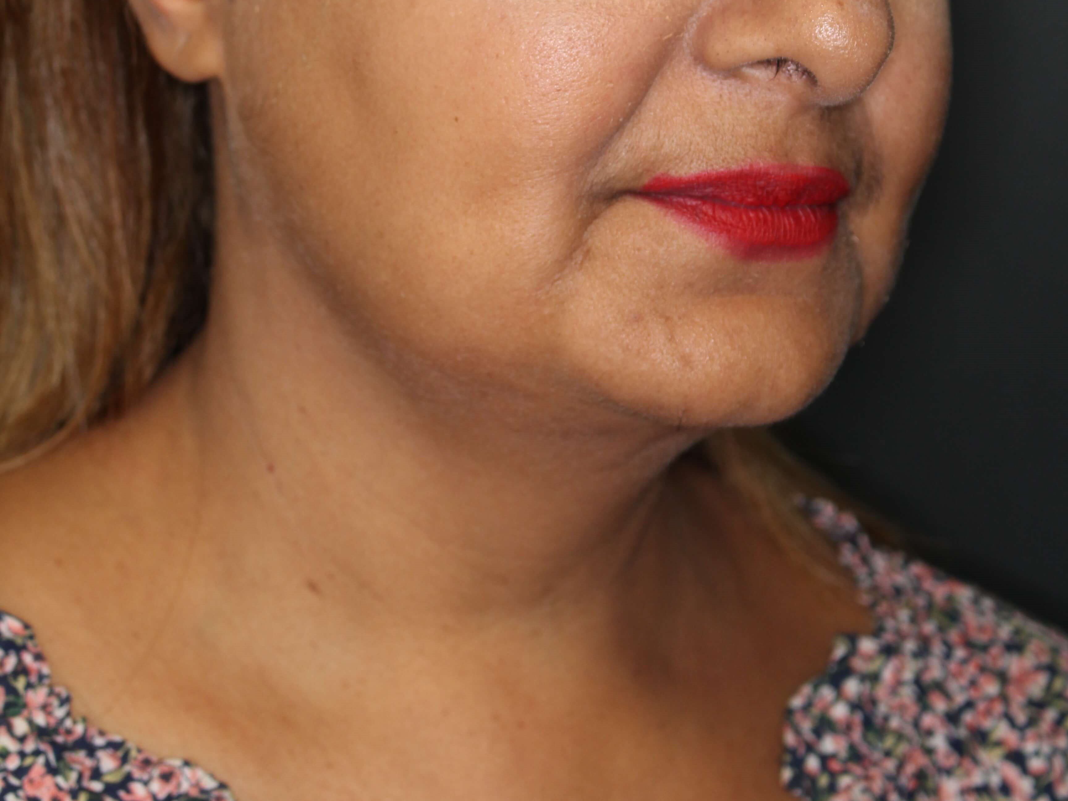 Awake Neck Liposuction After