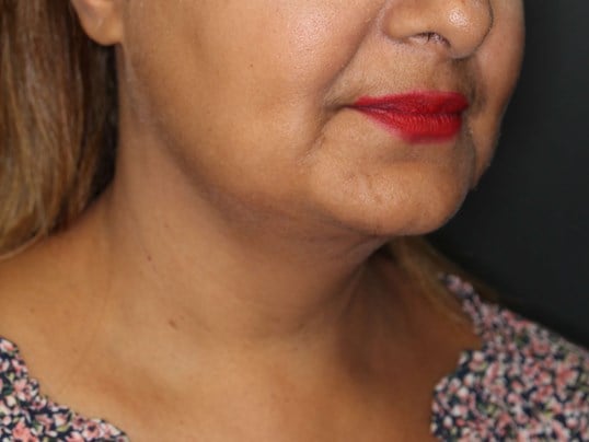 Awake Neck Liposuction After