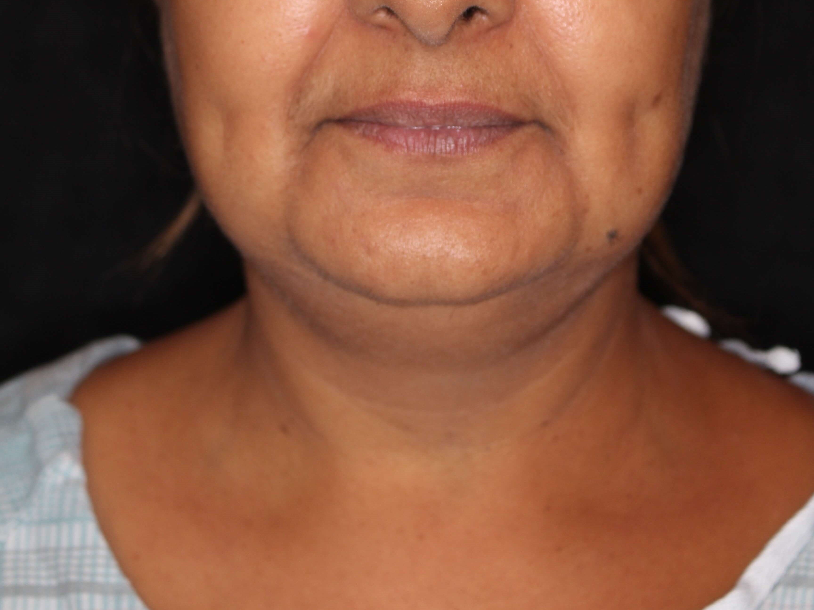 Awake Neck Liposuction Before