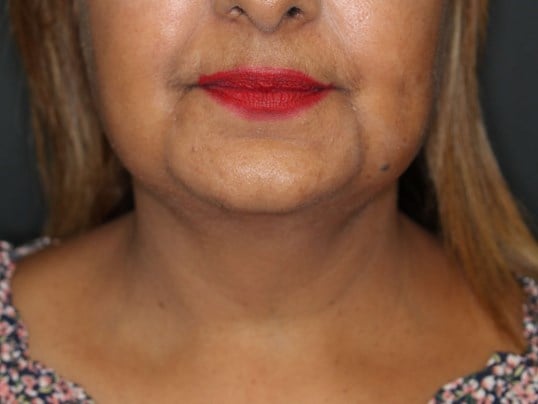 Awake Neck Liposuction After