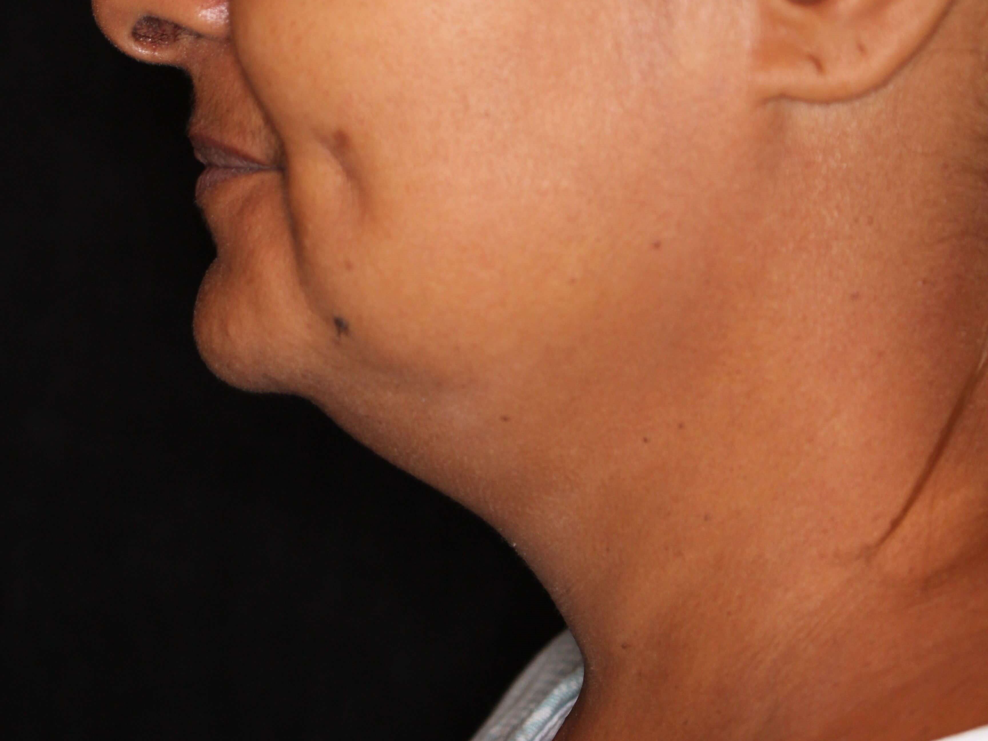 Awake Neck Liposuction Before