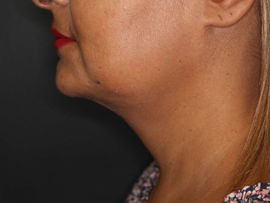 Awake Neck Liposuction After