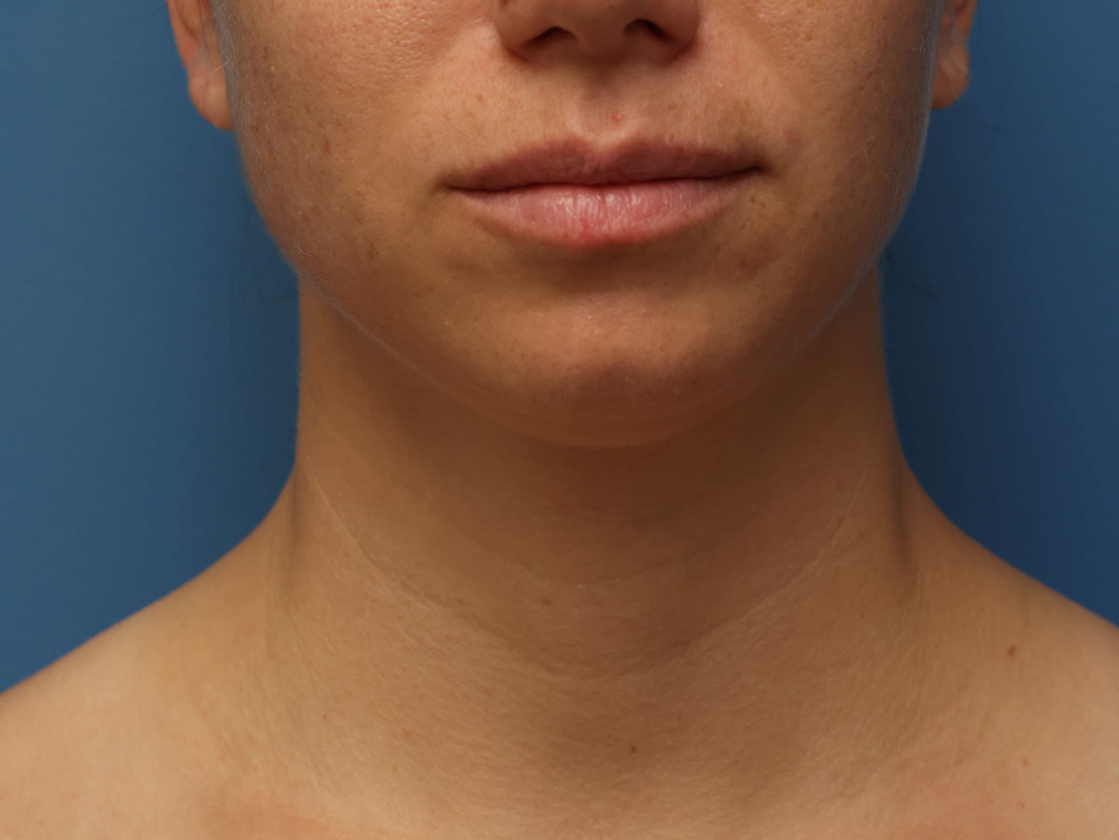 Awake Neck Liposuction Before