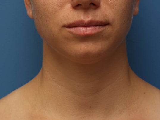 Awake Neck Liposuction Before