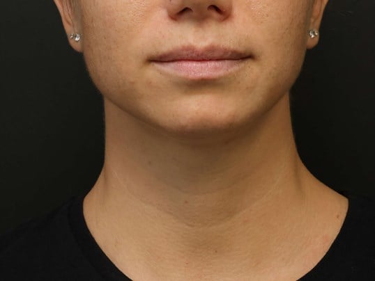 Awake Neck Liposuction After