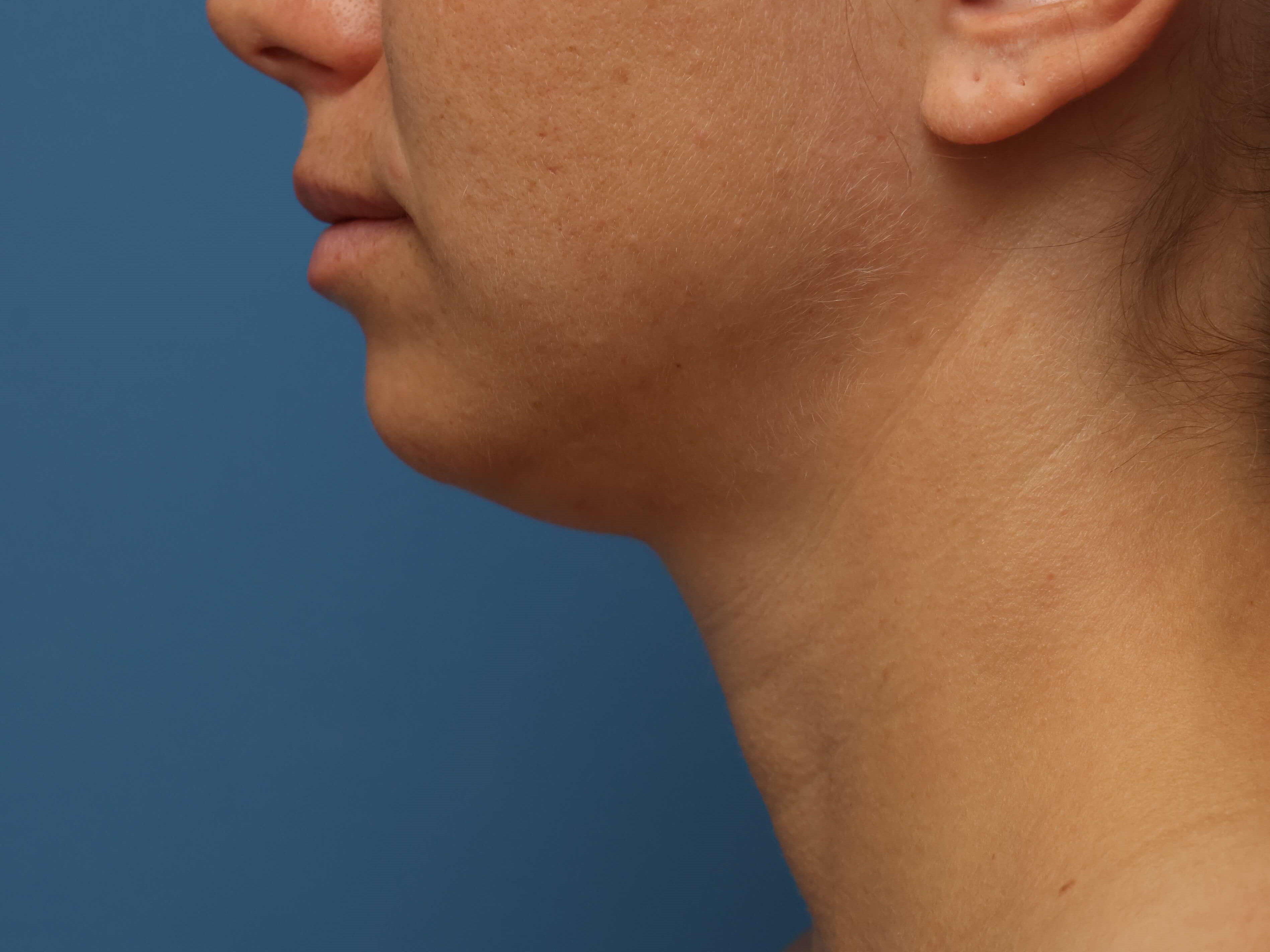 Awake Neck Liposuction Before