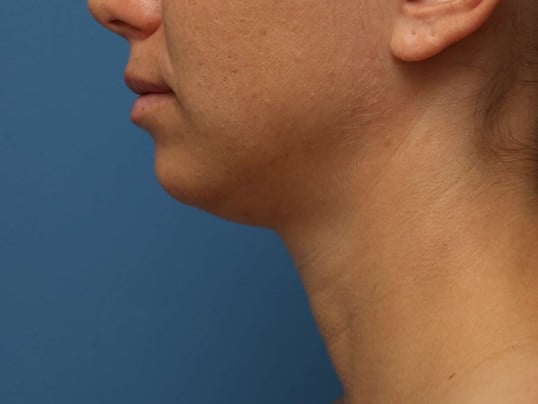 Awake Neck Liposuction Before