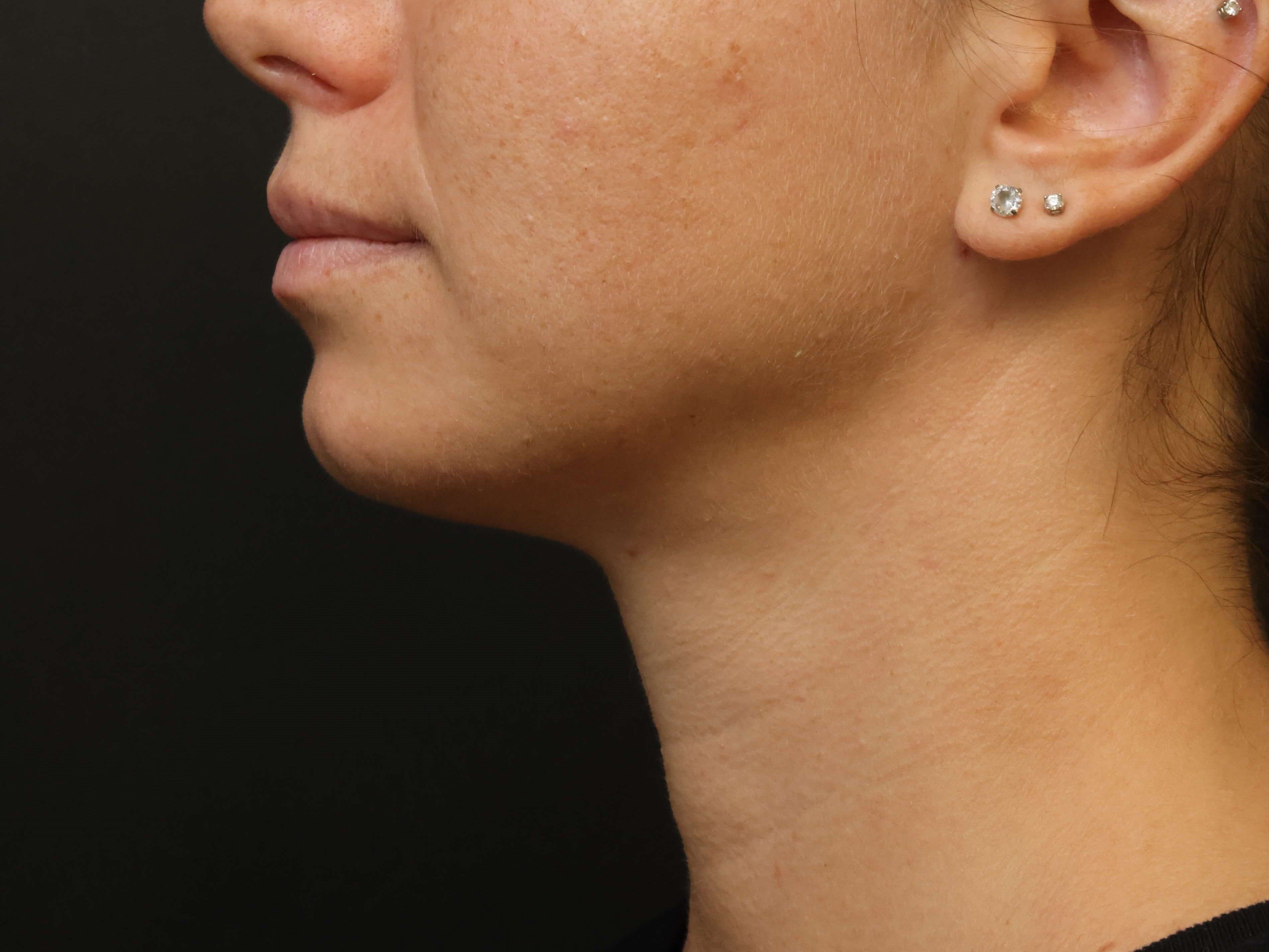 Awake Neck Liposuction After