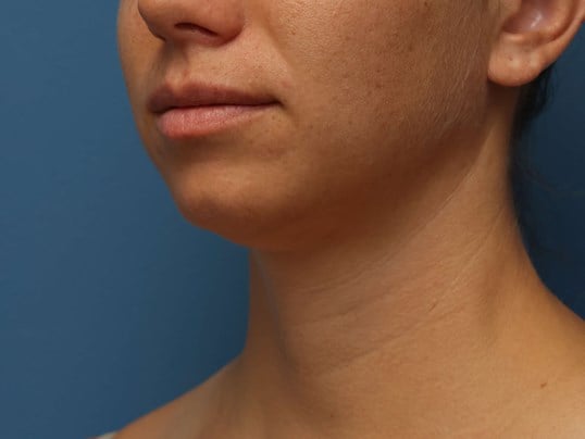 Awake Neck Liposuction Before