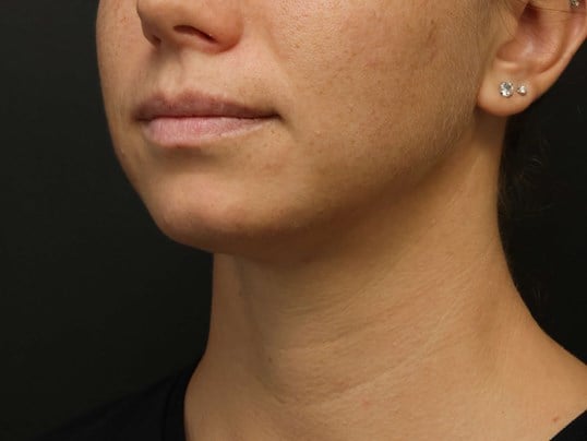 Awake Neck Liposuction After