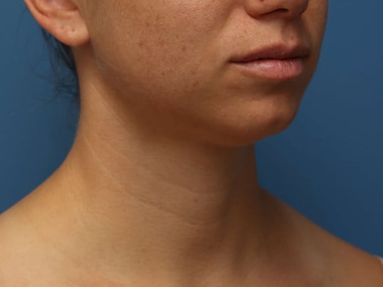 Awake Neck Liposuction Before
