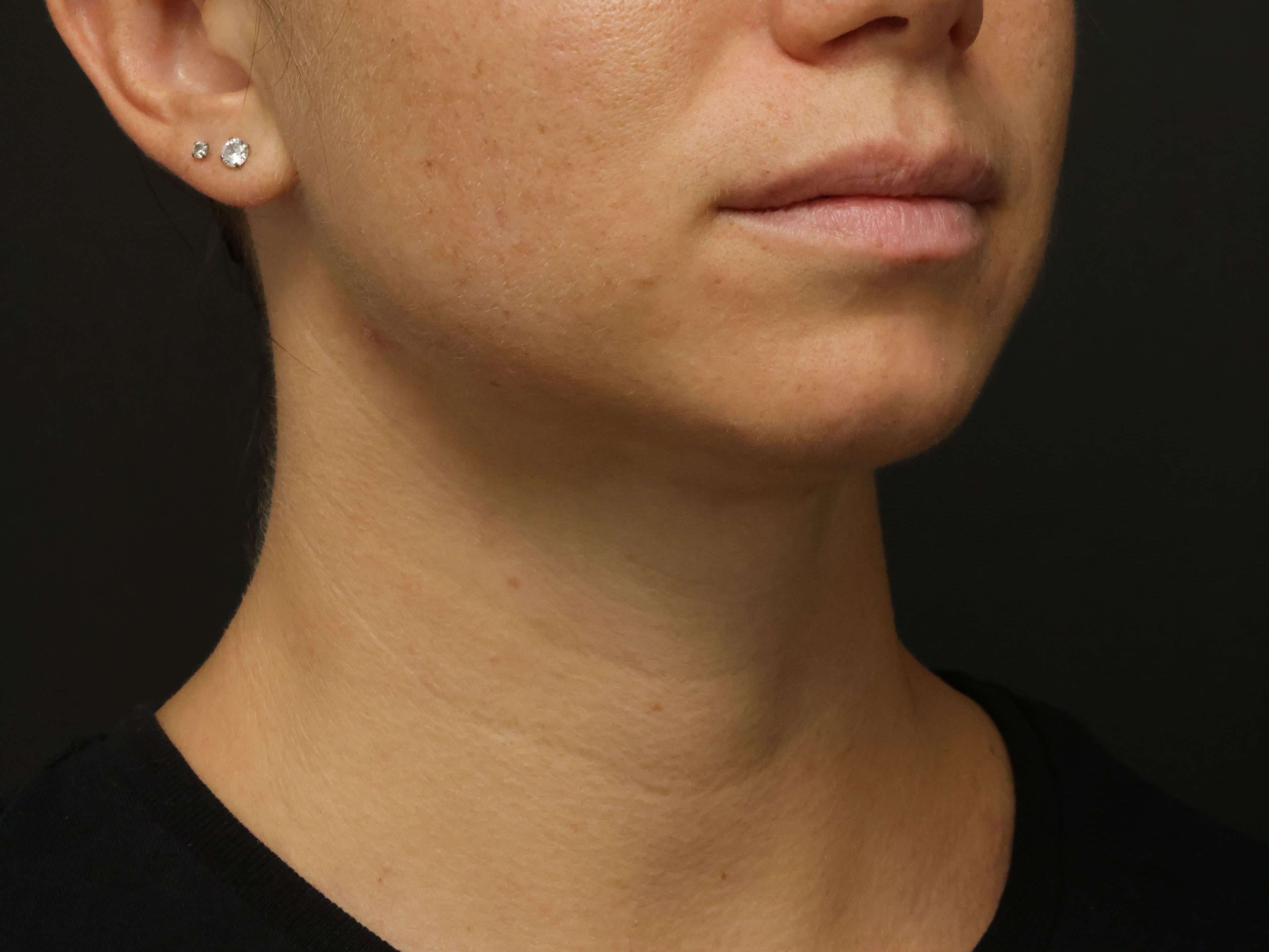 Awake Neck Liposuction After
