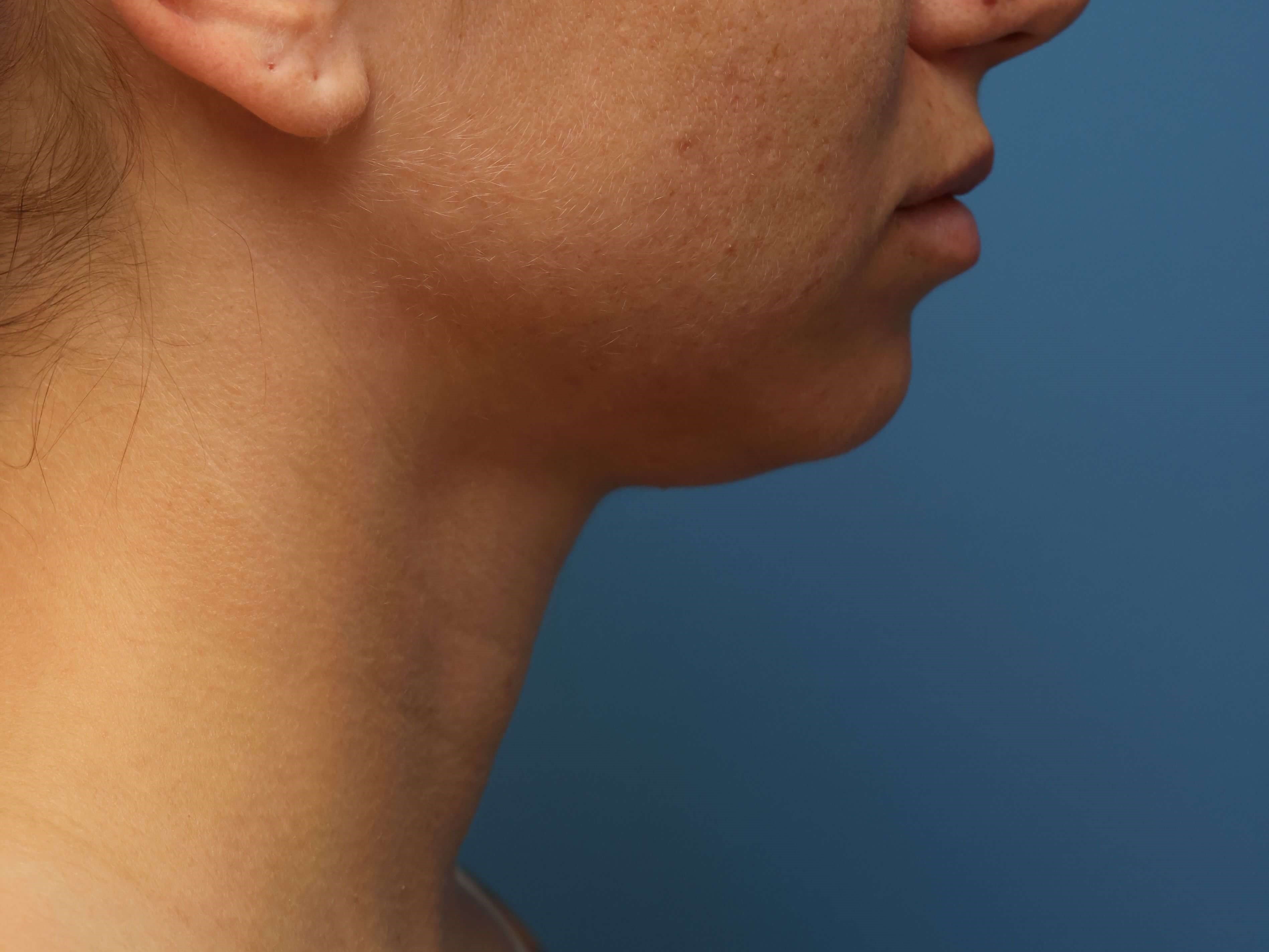 Awake Neck Liposuction Before