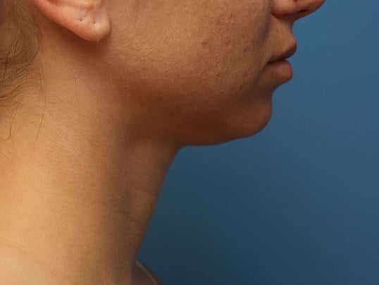 Awake Neck Liposuction Before
