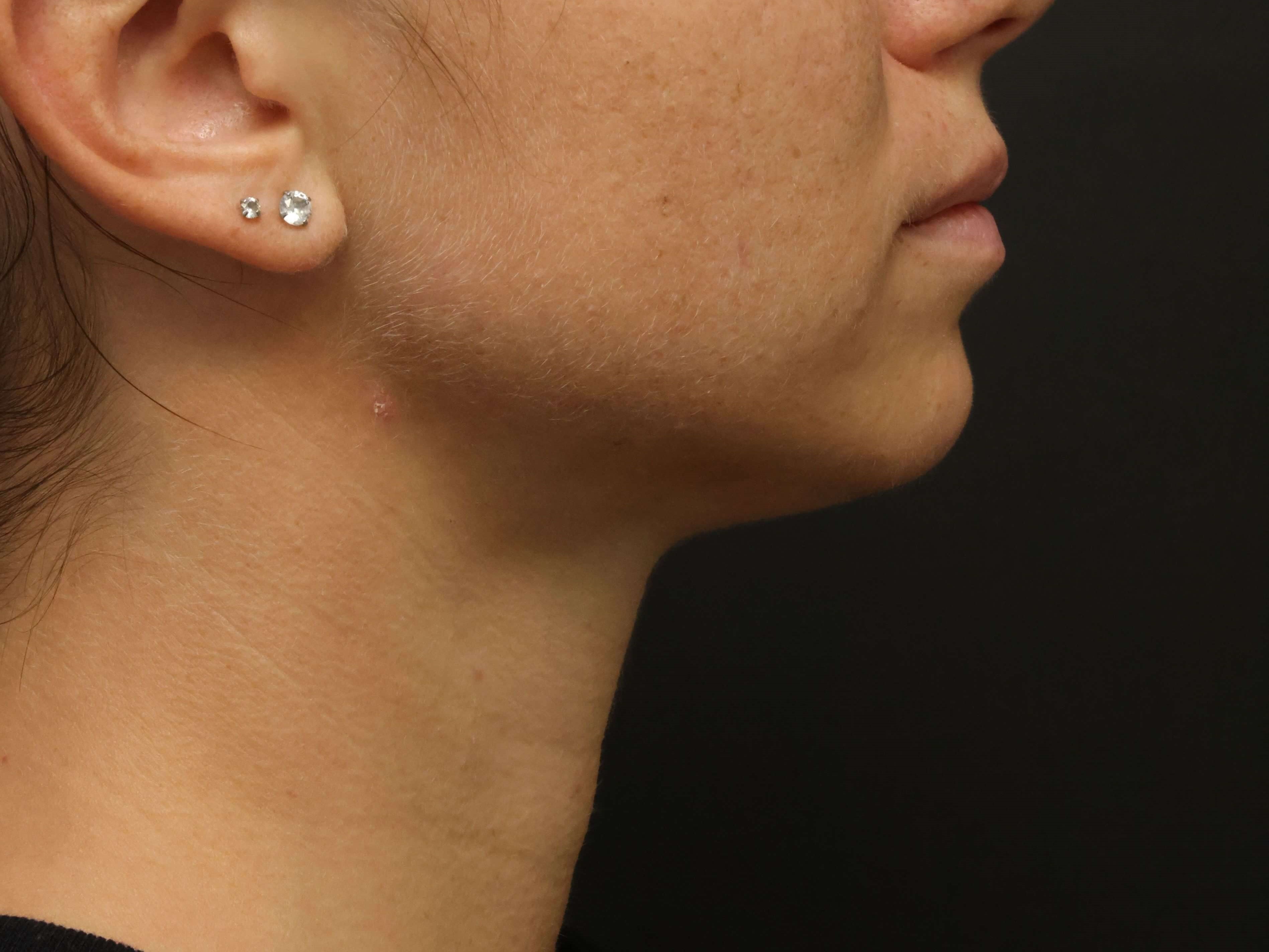 Awake Neck Liposuction After