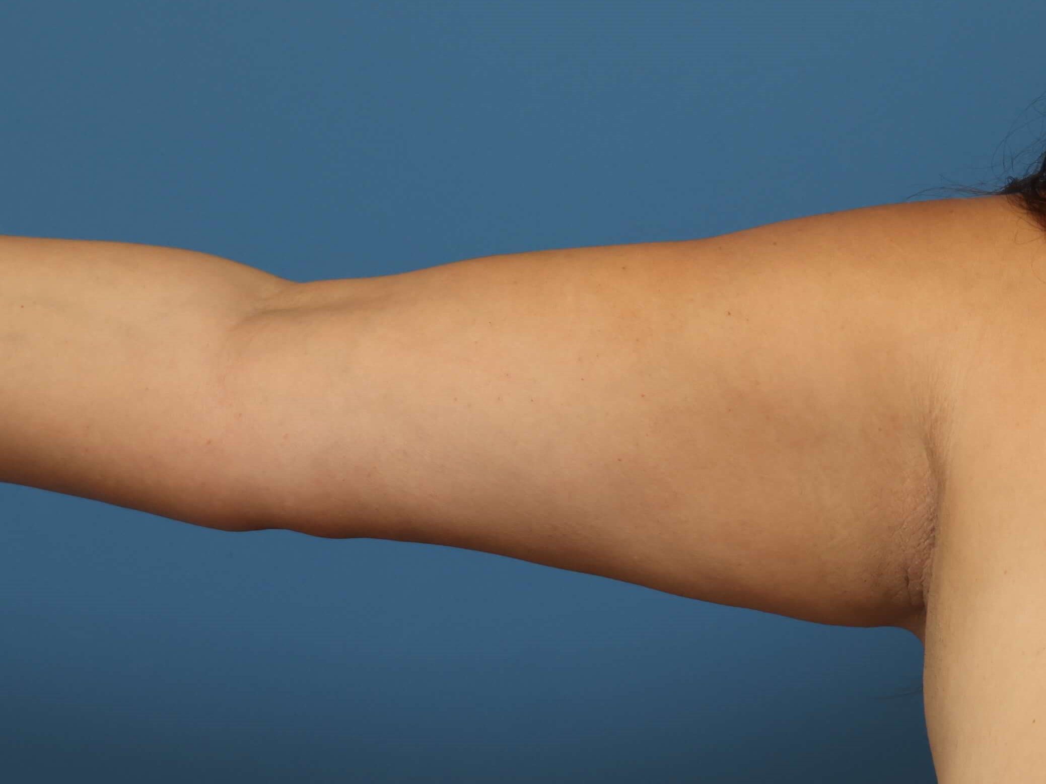 Awake Arm Liposuction Before