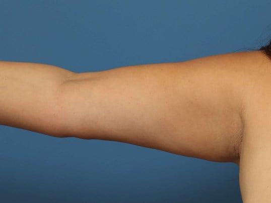 Awake Arm Liposuction Before