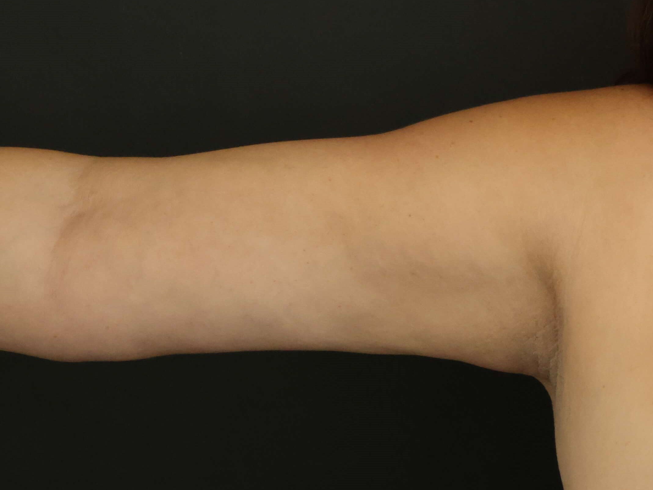 Awake Arm Liposuction After