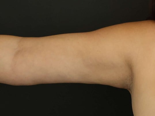 Awake Arm Liposuction After