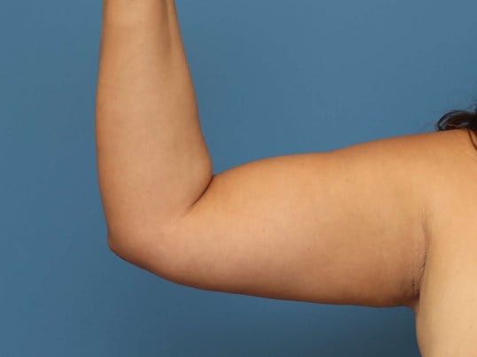 Awake Arm Liposuction Before