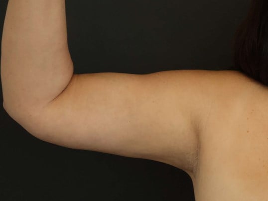 Awake Arm Liposuction After