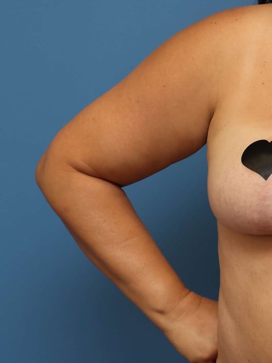 Awake Arm Liposuction Before