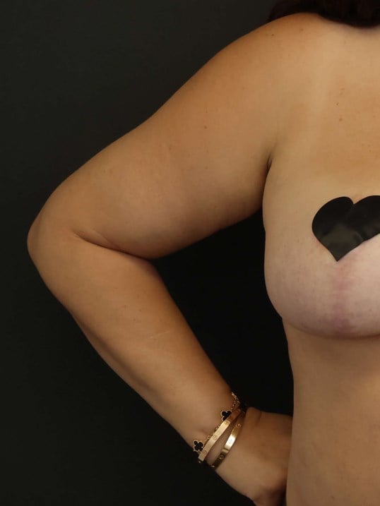 Awake Arm Liposuction After
