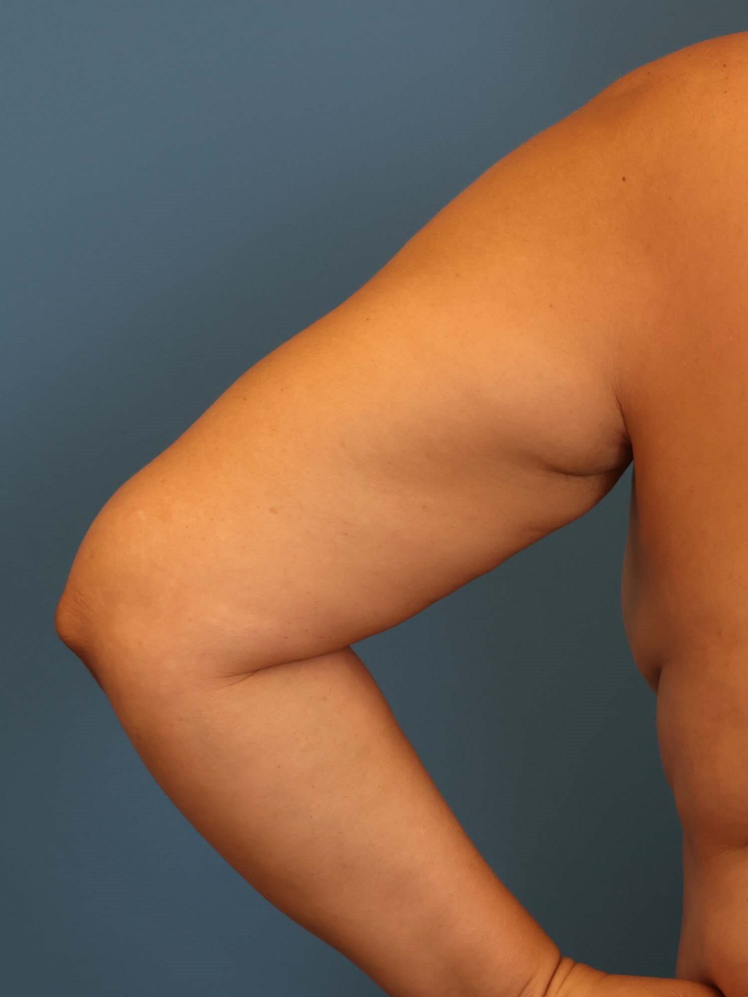 Awake Arm Liposuction Before