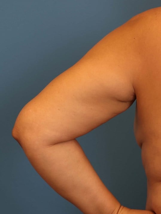 Awake Arm Liposuction Before