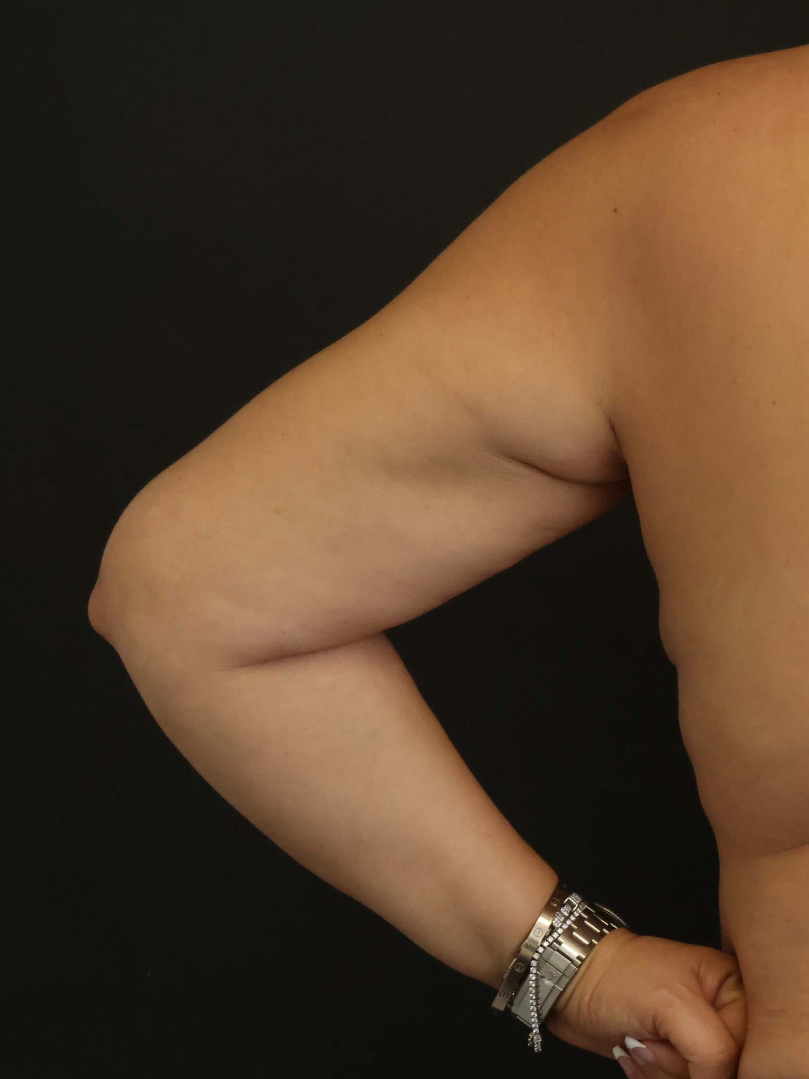 Awake Arm Liposuction After