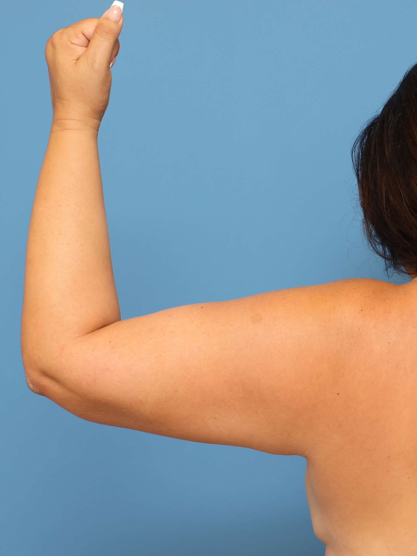 Awake Arm Liposuction Before