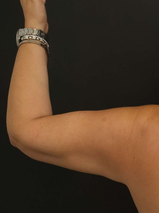 Awake Arm Liposuction After