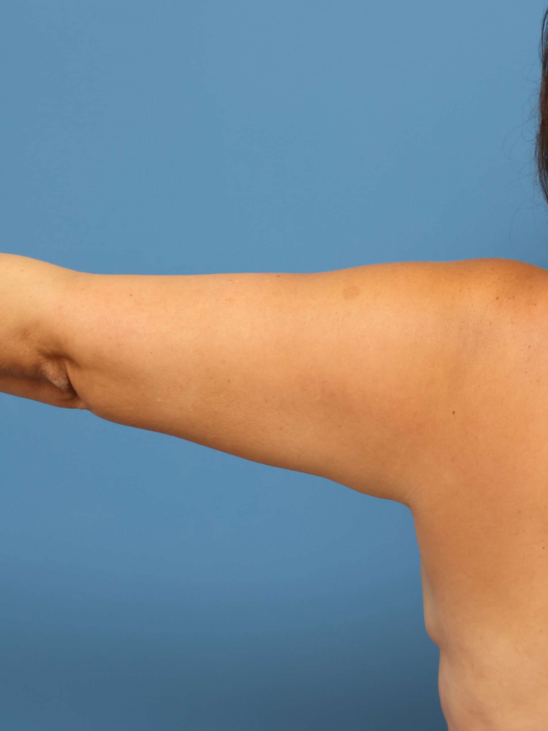 Awake Arm Liposuction Before