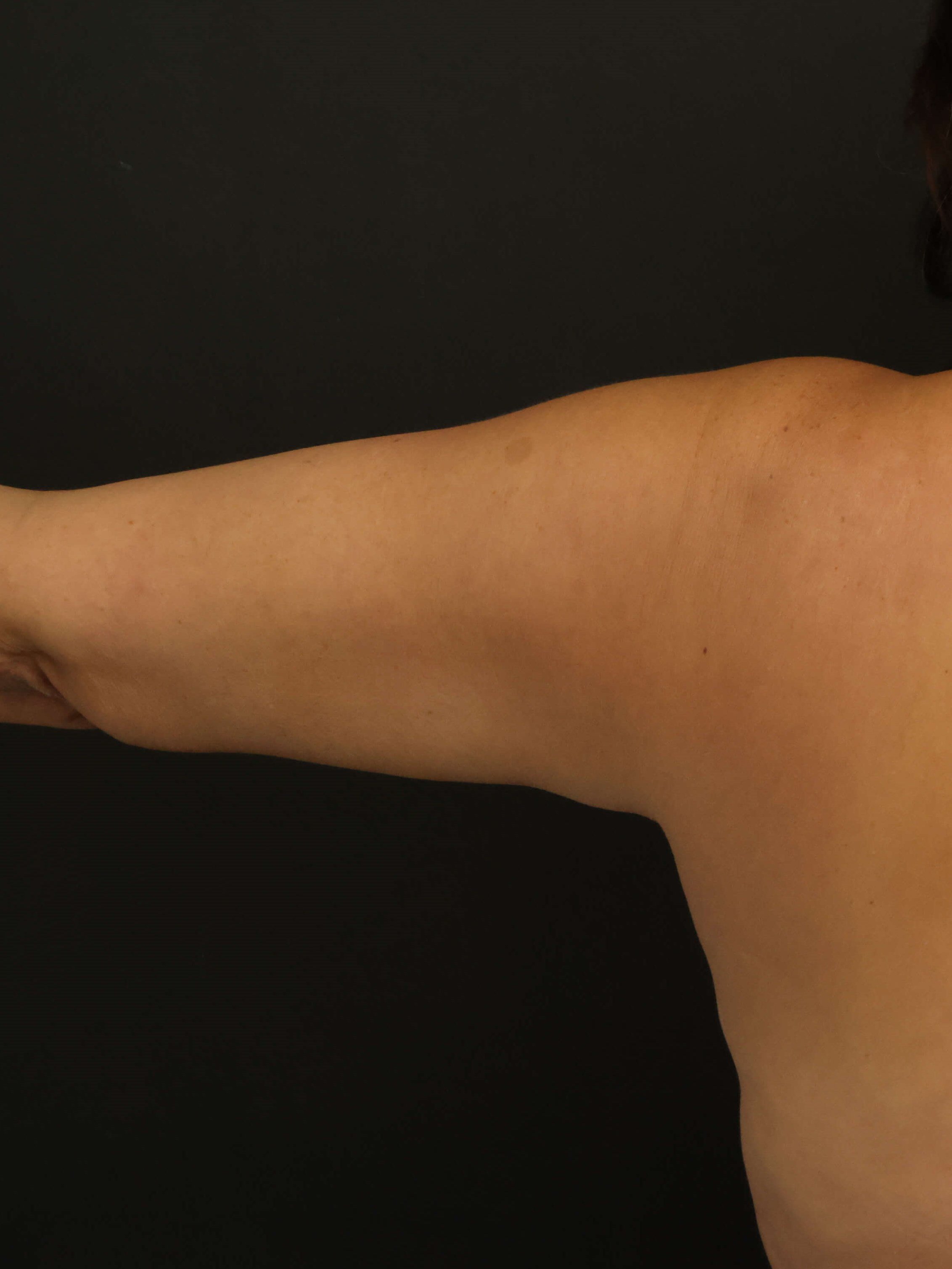Awake Arm Liposuction After