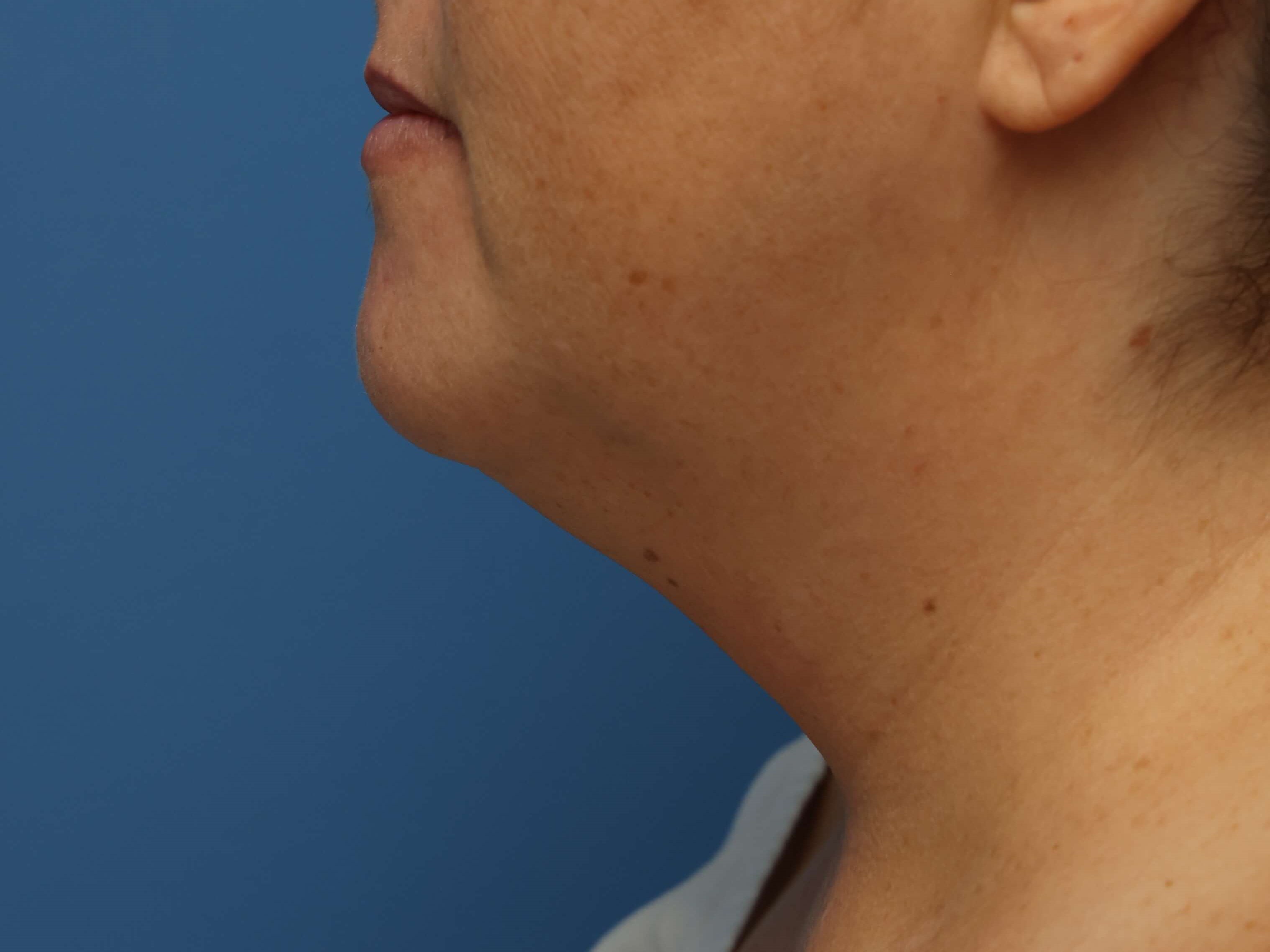 Awake Neck Liposuction Before
