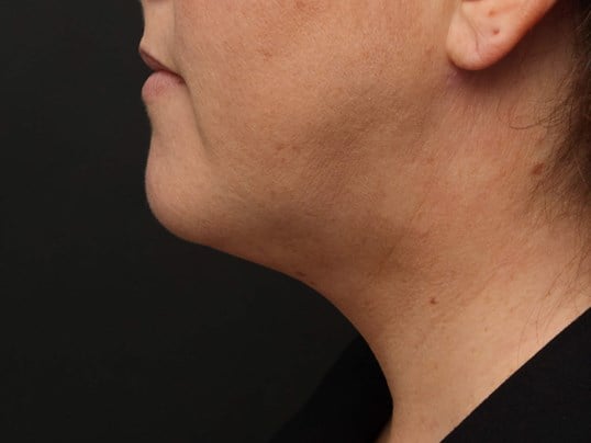 Awake Neck Liposuction After