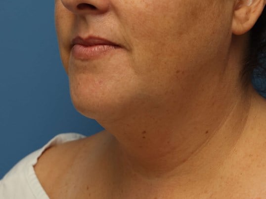Awake Neck Liposuction Before
