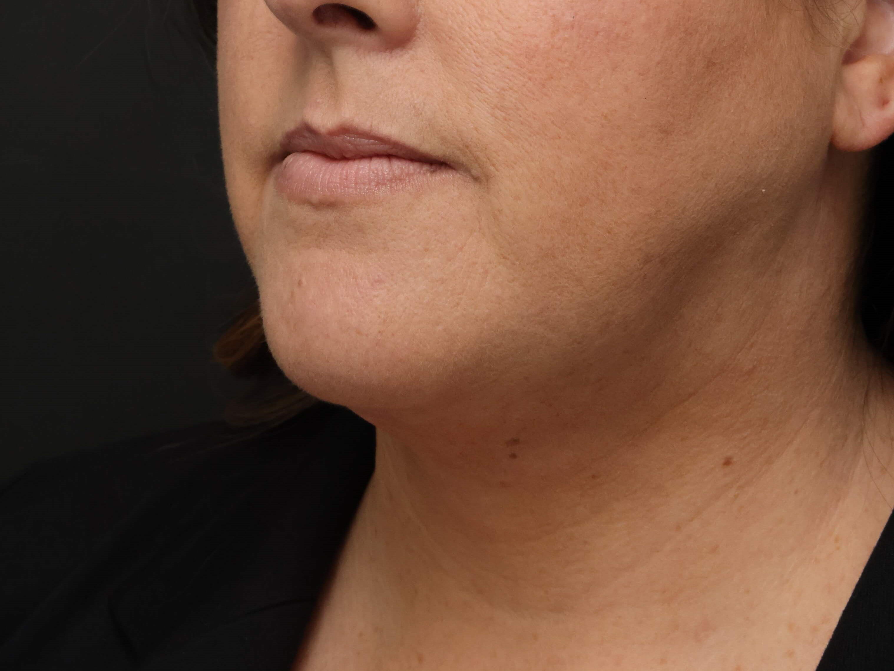 Awake Neck Liposuction After