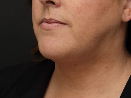 Awake Neck Liposuction After