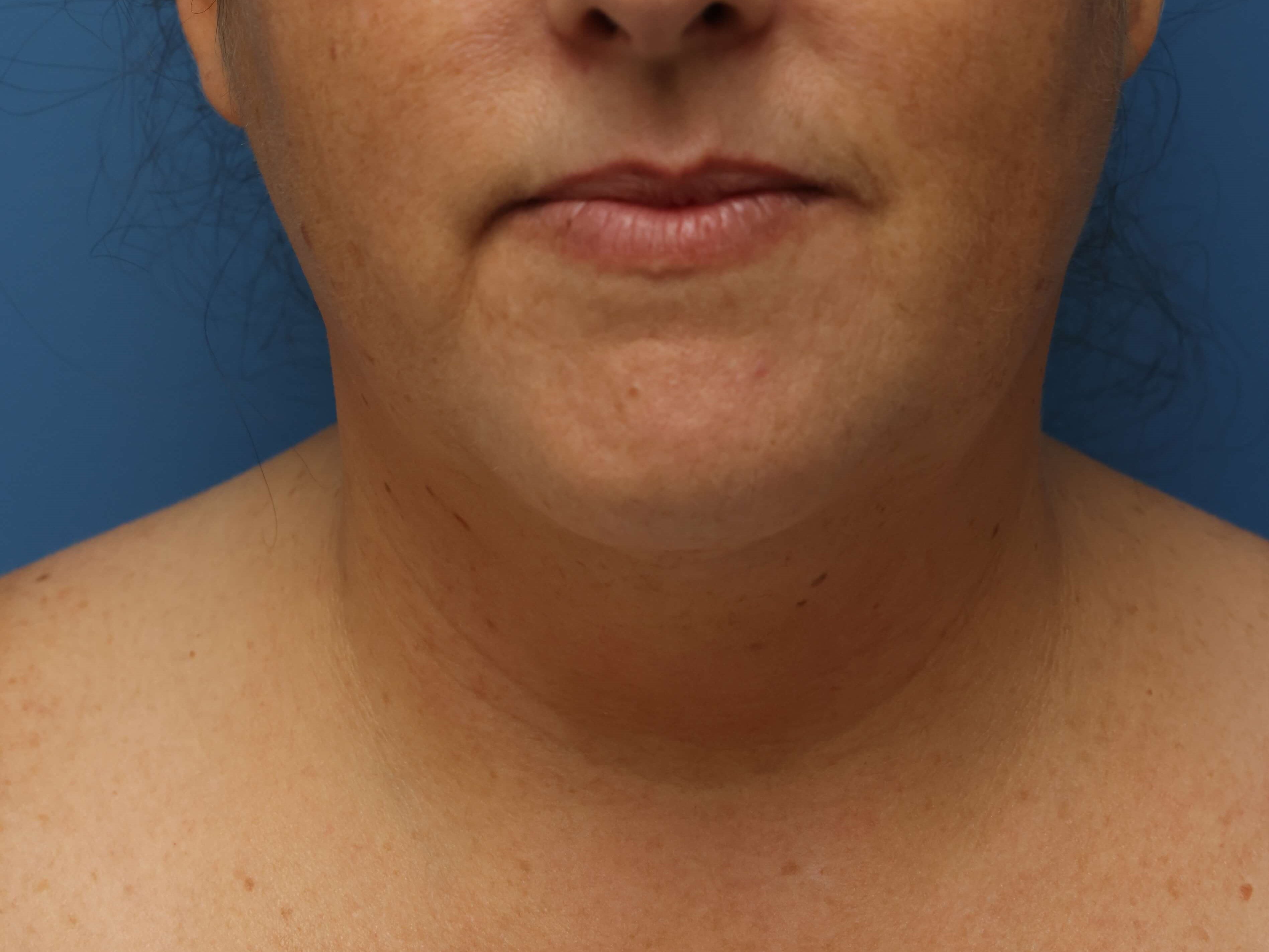 Awake Neck Liposuction Before