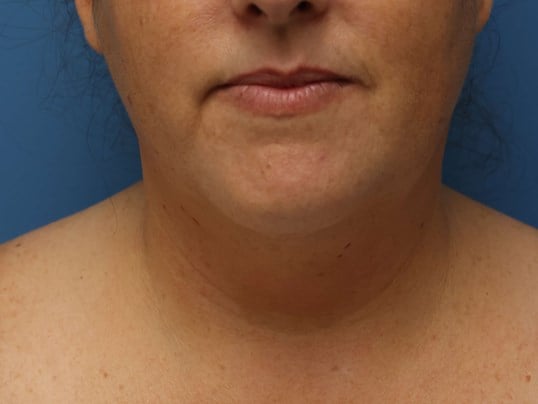 Awake Neck Liposuction Before