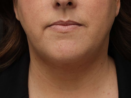 Awake Neck Liposuction After