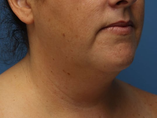 Awake Neck Liposuction Before