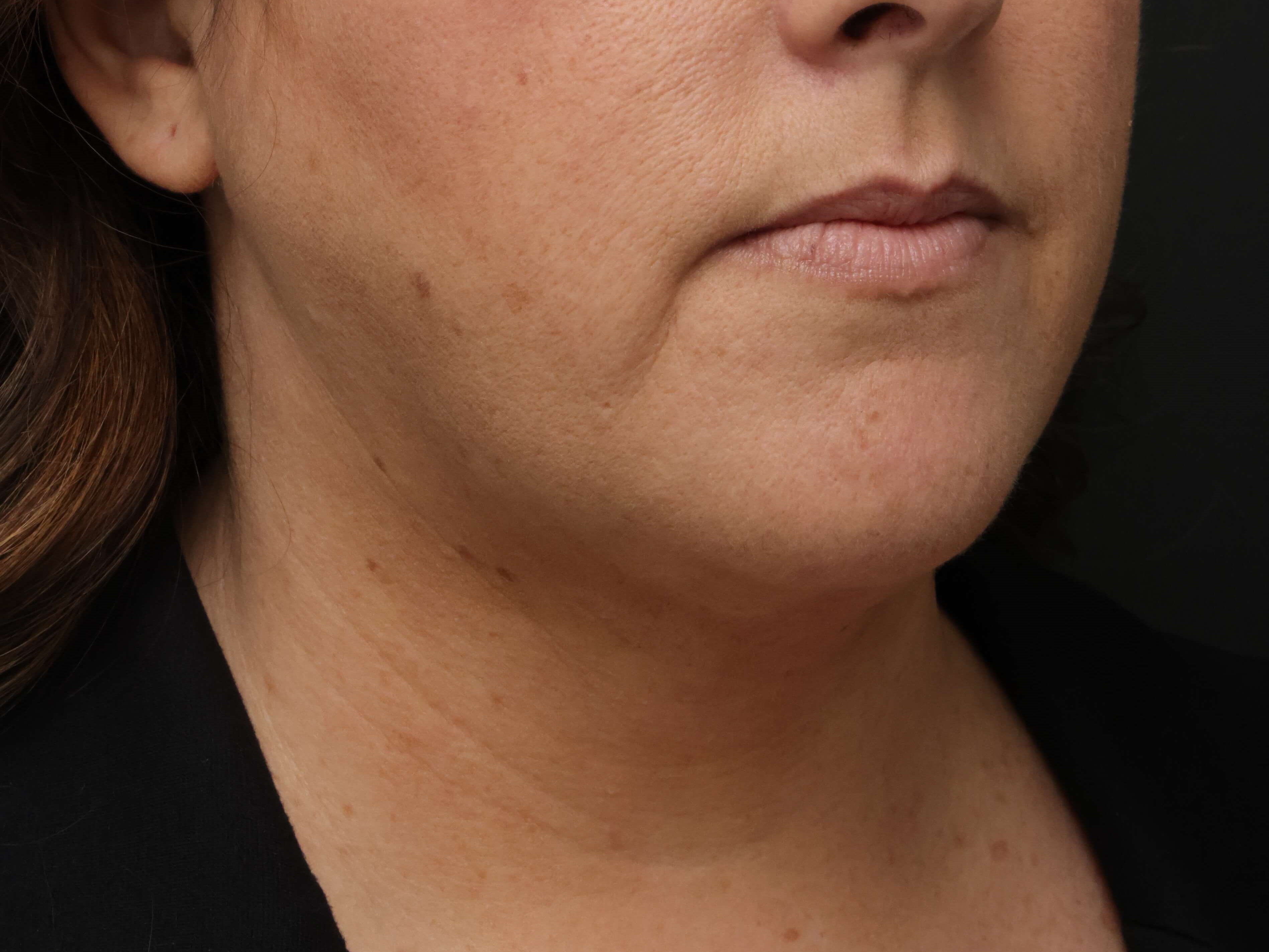 Awake Neck Liposuction After