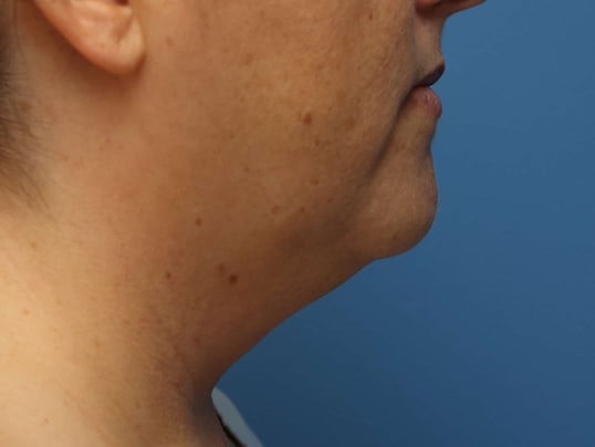 Awake Neck Liposuction Before