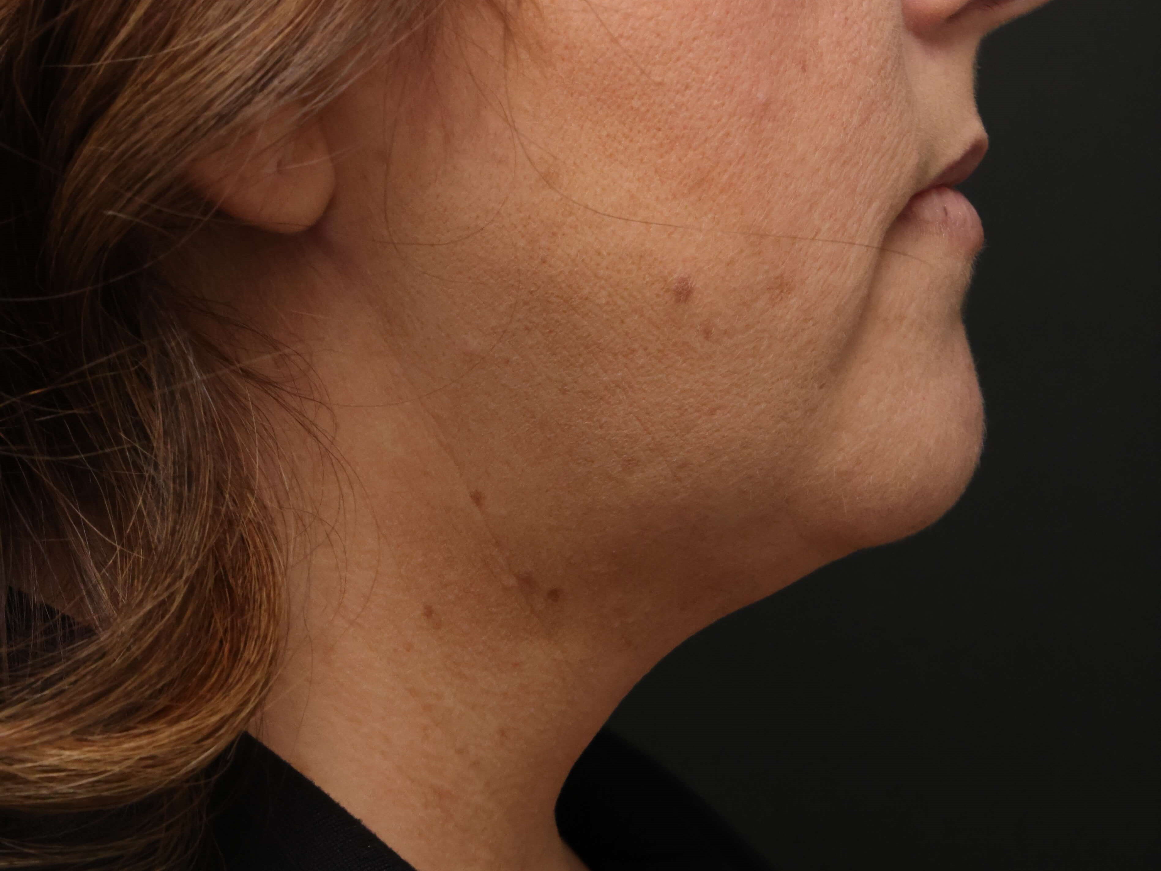 Awake Neck Liposuction After
