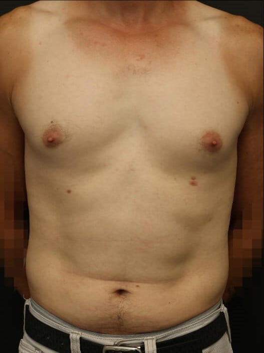 Awake Lipo of Chest & Abdomen Before