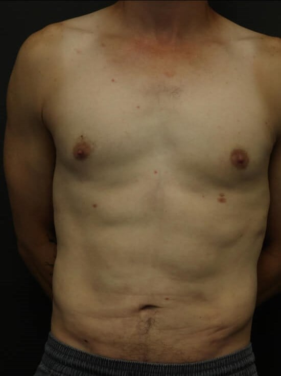 Awake Lipo of Chest & Abdomen After