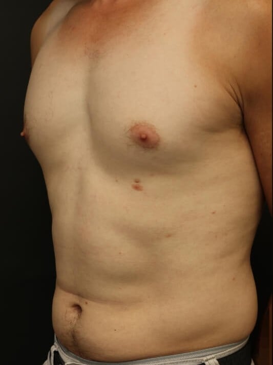 Awake Lipo of Chest & Abdomen Before